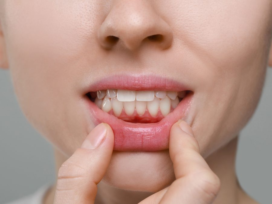 Temsili görsel: Diş Eti Tedavileri (Periodontoloji)